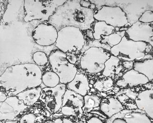 M,50y. | Pneumocystis carinii M,50y. | Pneumocystis carinii